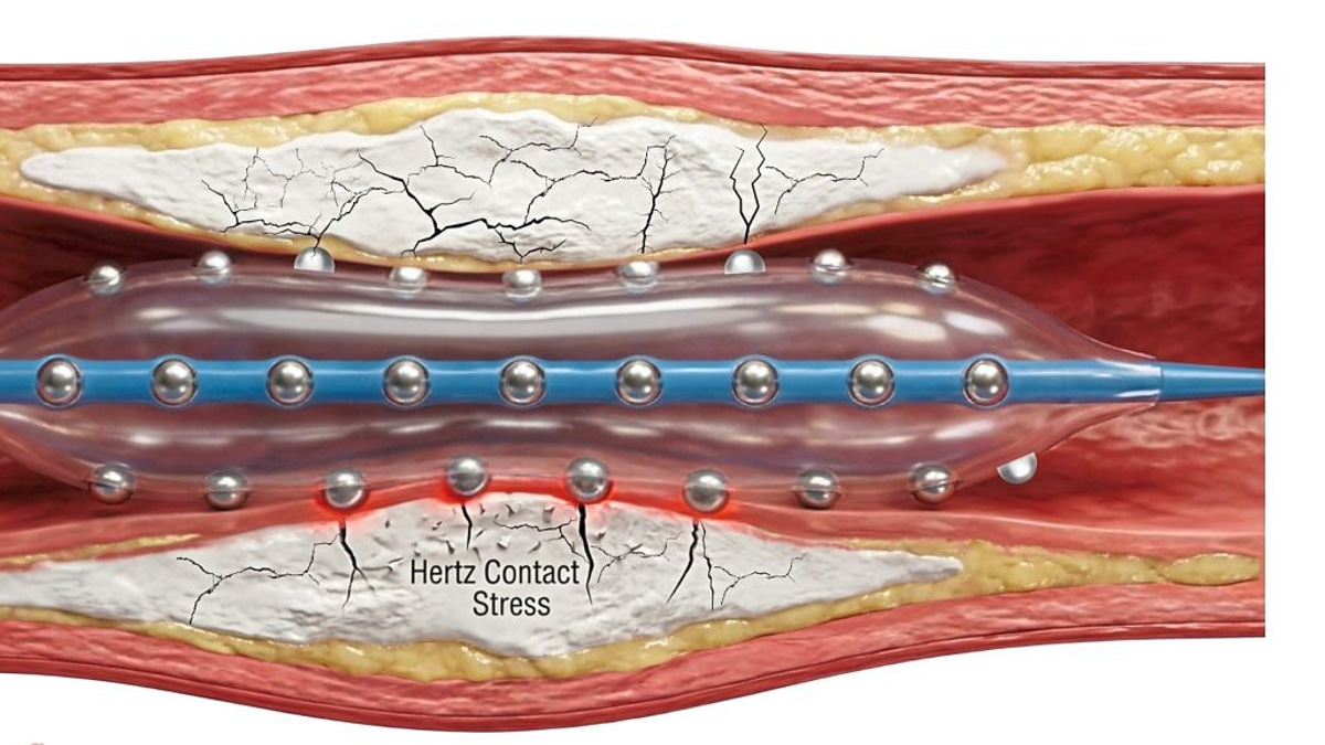 Malaysian Cardiologists Test Breakthrough Technology for Hardened Heart Artery Disease