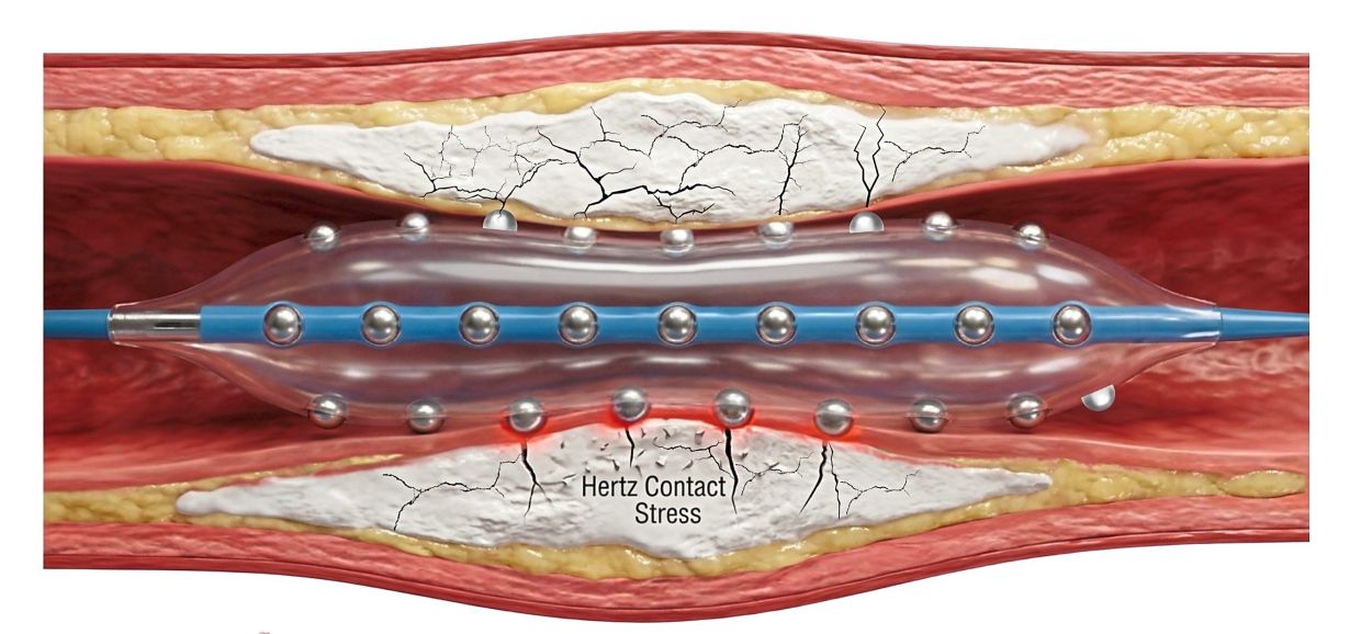 Malaysian Cardiologists Test Breakthrough Technology for Hardened Heart Artery Disease